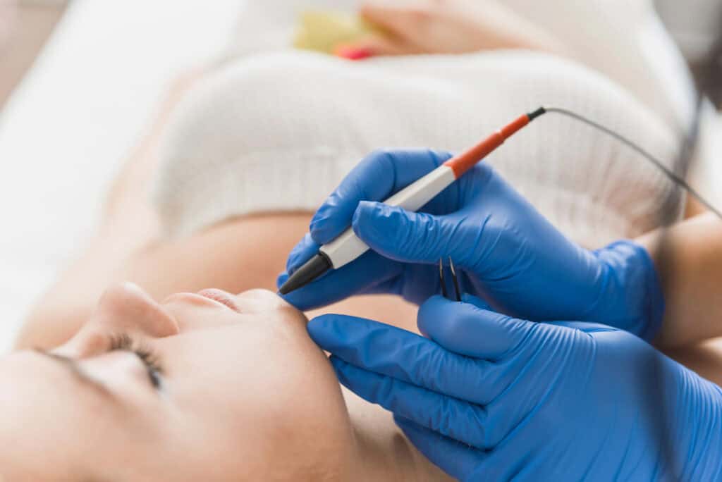 A person is receiving an electrolysis treatment on their chin. The practitioner is holding a tool and wearing blue gloves.